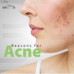 ⁦BG Acne Prone Skin Cream – 30 ml – Cream for Combination to Oily Skin for Visible Results on Imperfections Blackheads - Dark Spot Correction - Solve oily and acne prone skin problems⁩ - الصورة ⁦2⁩