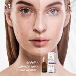 ⁦IGEA Retinol Serum – With 1% Retinol & Vitamin E | Niacinamide | Reduce Fine Lines, and Refine Pores | Hydration and Nourishment.⁩ - الصورة ⁦5⁩