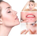 ⁦رقعة علاج حب الشباب 💛❇️ نضعها على البثور لمدة 8 ساعات لتجفيفها بشكل فعال ❤️ تمتص البكتيريا الموجودة في البثور بسرعة وتمنع الندبات ❤️ تبقى ثابتة حتى مع التعرض للماء. (48 لصقه)⁩ - الصورة ⁦5⁩