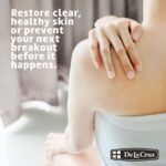 ⁦علاج حب الشباب مع 10% كبريت من دي لا كروز- حجم صغير (6 جرام)⁩ - الصورة ⁦4⁩
